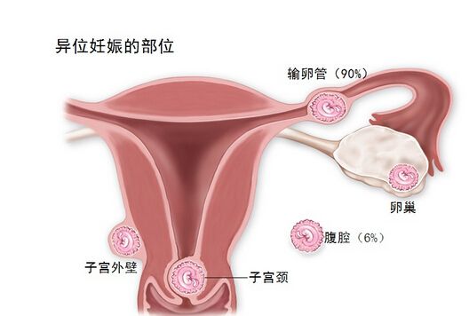 做试管会出现宫外孕吗？