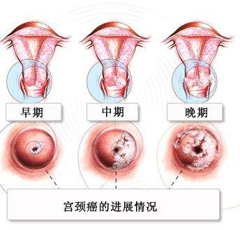 如何有效预防宫颈癌？