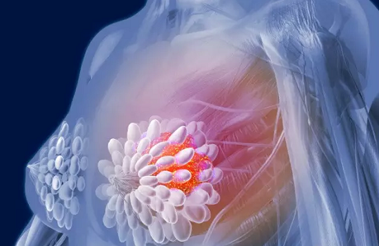 乳腺癌早期前兆都有哪些呢？